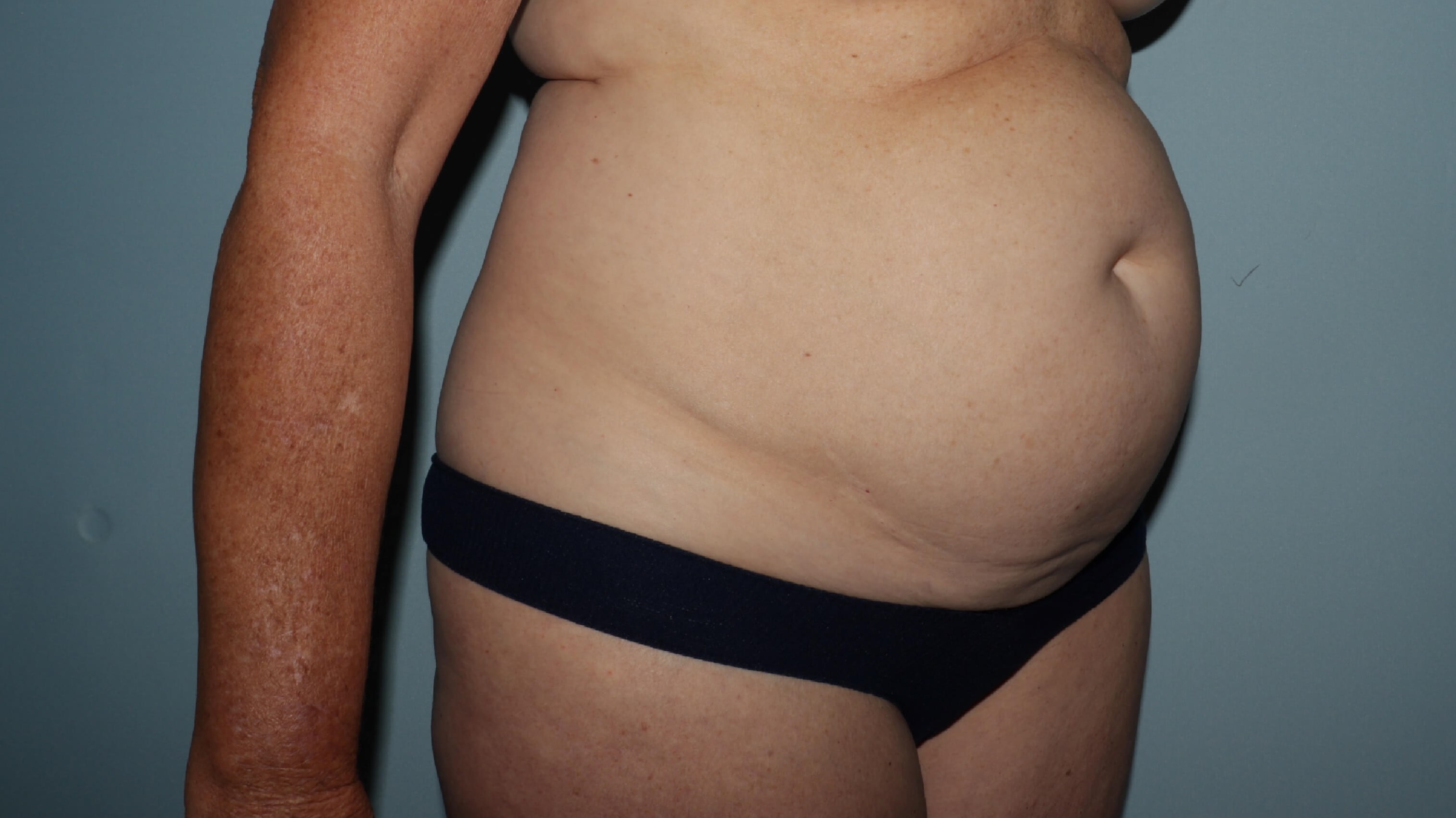 Oblique preop
